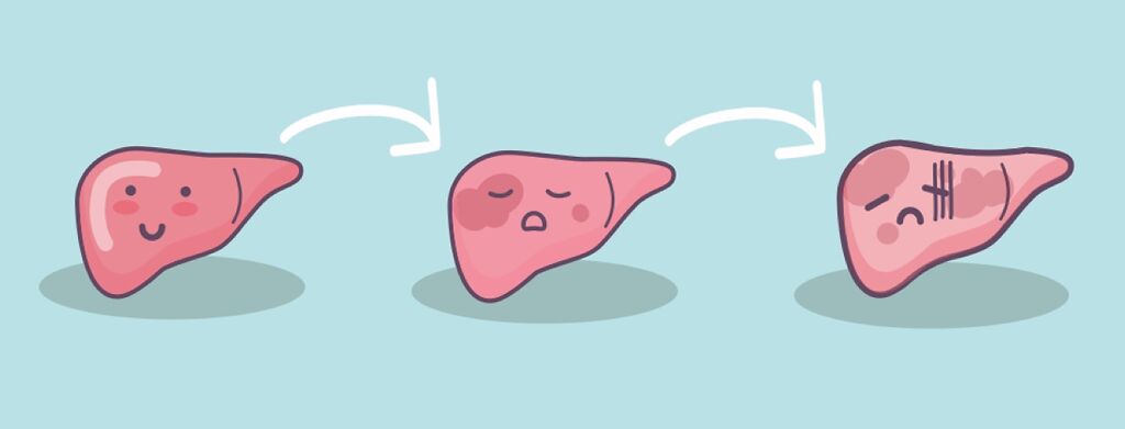 Series of cartoon livers showing the stages of liver cirrhosis