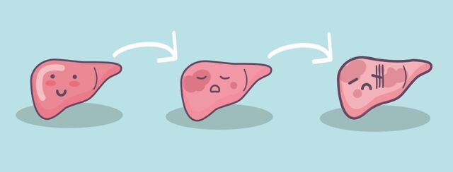 Understanding Cirrhosis of the Liver image