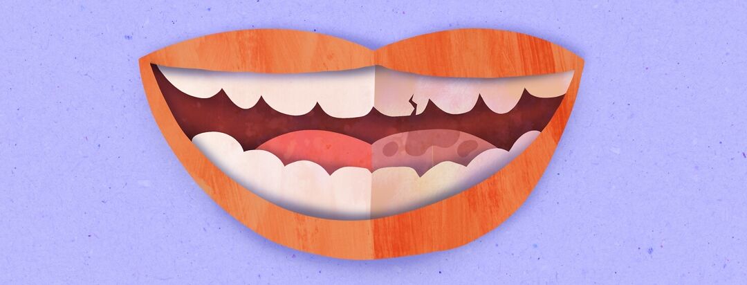 Dental Problems With Liver Disease image