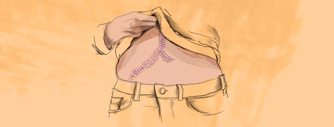 What It’s Like To Have a Liver Transplant image