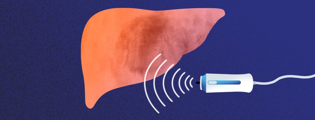 What I Know About FibroScans image